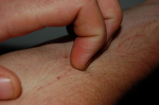 coceira na pel como síntoma da presenza de parasitos