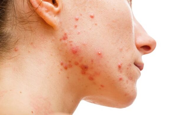 acne debido a parasitos subcutáneos
