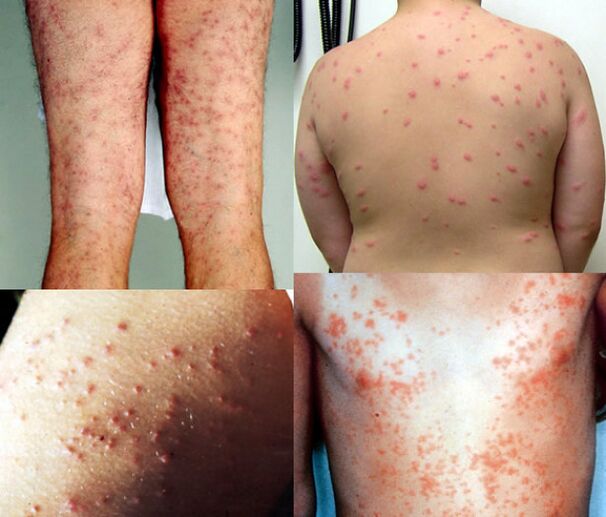 erupción cutánea en todo o corpo debido a parasitos