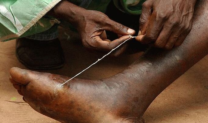 extracción do parasito subcutáneo do pé