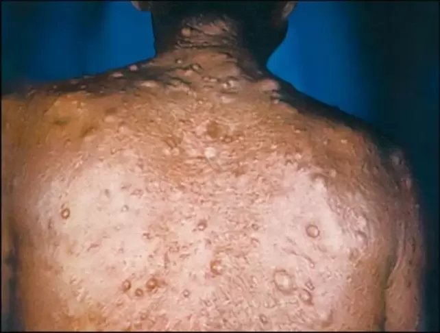 nódulos purulentos na pel debido a parasitos