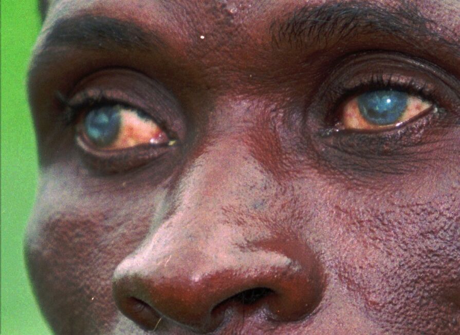 parasitos nos ollos humanos